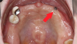 Mini Dental Implant to support upper Denture